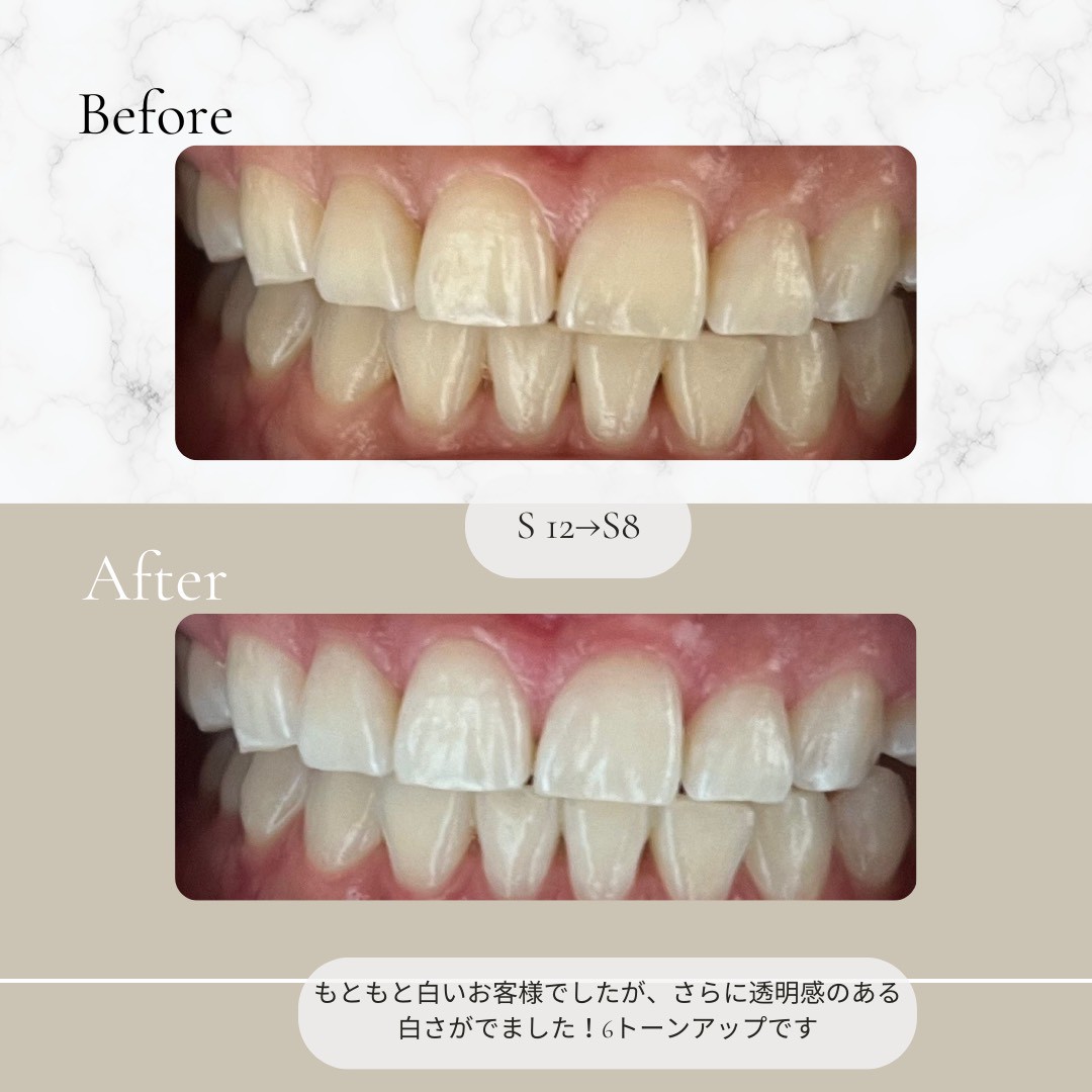 ホワイトニング ビフォーアフター